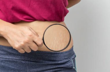 Come prevenire le smagliature o attenuarne l’effetto? Ecco quali sono i migliori sistemi naturali