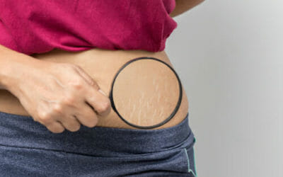 Come prevenire le smagliature o attenuarne l’effetto? Ecco quali sono i migliori sistemi naturali