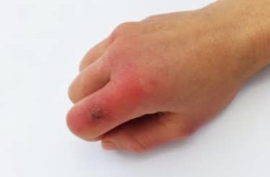 Comment prévenir et traiter les engelures sur les mains et les pieds de manière naturelle