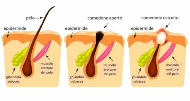 Tutto sui brufoli: quali sono le cause e come curarli naturalmente