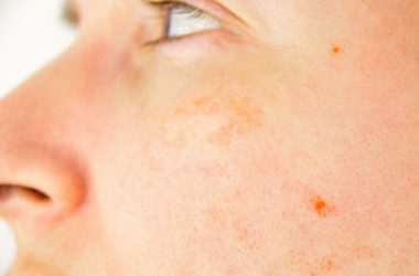 Tutto sulle macchie solari, come prevenirle e come curarle con i migliori rimedi naturali e dermatologici