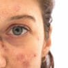 Tutto sulle macchie solari, come prevenirle e come curarle con i migliori rimedi naturali e dermatologici