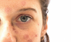Tutto sulle macchie solari, come prevenirle e come curarle con i migliori rimedi naturali e dermatologici
