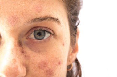 Tutto sulle macchie solari, come prevenirle e come curarle con i migliori rimedi naturali e dermatologici