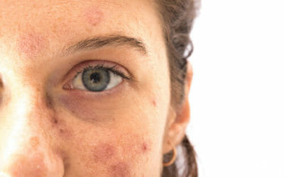 Tutto sulle macchie solari, come prevenirle e come curarle con i migliori rimedi naturali e dermatologici