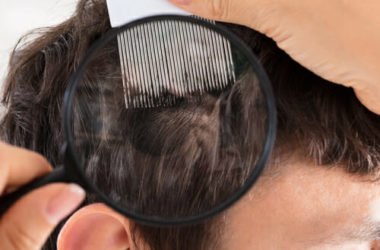 Lenire i disturbi della psoriasi in modo naturale: ecco i migliori sistemi