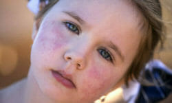Macchie rosse sulla pelle, tutte le possibile cause