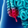Appendicite: come riconoscere i sintomi iniziali e cure possibili