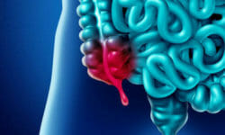 Appendicite: come riconoscere i sintomi iniziali e cure possibili