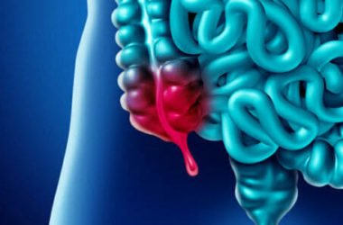 Appendicite: come riconoscere i sintomi iniziali e cure possibili