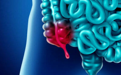 Appendicite: come riconoscere i sintomi iniziali e cure possibili