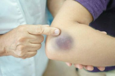 Cos’è una ecchimosi: quali sono le cause e quali i metodi per ridurlo in fretta