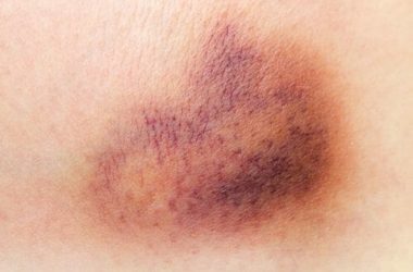 Cos’è una ecchimosi: quali sono le cause e quali i metodi per ridurlo in fretta