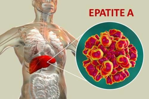 Tutto sull’epatite A: quali sono i sintomi, quali precauzioni prendere e i rimedi per guarire