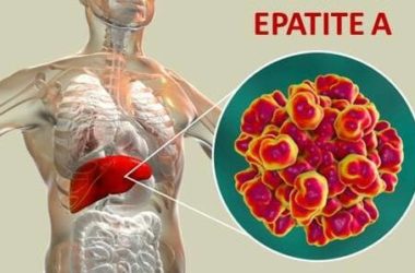 Tutto sull’epatite A: quali sono i sintomi, quali precauzioni prendere e i rimedi per guarire