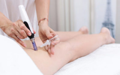 Tutto sulla mesoterapia, in cui si iniettano farmaci direttamente sottopelle: quali i benefici, come si esegue e quali sono i risultati