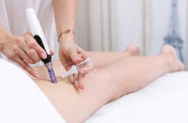 Tutto sulla mesoterapia, in cui si iniettano farmaci direttamente sottopelle: quali i benefici, come si esegue e quali sono i risultati