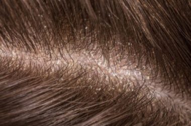 Cuoio capelluto: secco o grasso tutti i rimedi naturali per tenerlo pulito, sano e profumato