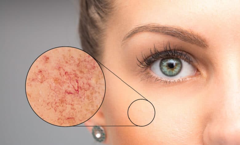 capillari rotti: come prevenire