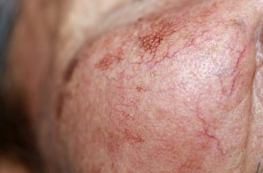 Capillari rotti: come prevenire e curare la fragilità dei capillari