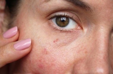 Capillari rotti: come prevenire e curare la fragilità dei capillari