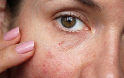 Capillari rotti: come prevenire e curare la fragilità dei capillari