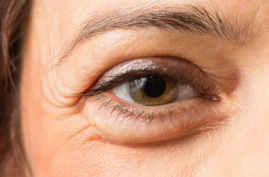 Come eliminare in modo naturale le odiate borse sotto gli occhi, perché si formano e a quale età