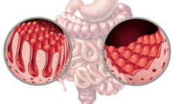 Come riconoscere e cosa fare in caso di malassorbimento intestinale, una situazione debilitante e assai diffusa