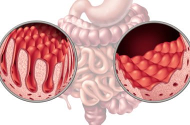 Come riconoscere e cosa fare in caso di malassorbimento intestinale, una situazione debilitante e assai diffusa