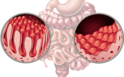 Come riconoscere e cosa fare in caso di malassorbimento intestinale, una situazione debilitante e assai diffusa