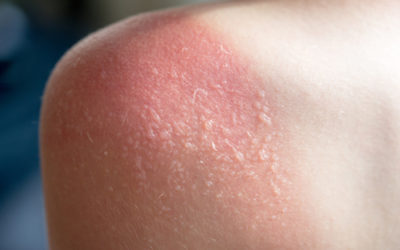 I rimedi naturali per l’eritema solare: dalle sostanze ricche di amido all’aloe vera, dalla malva e alla camomilla
