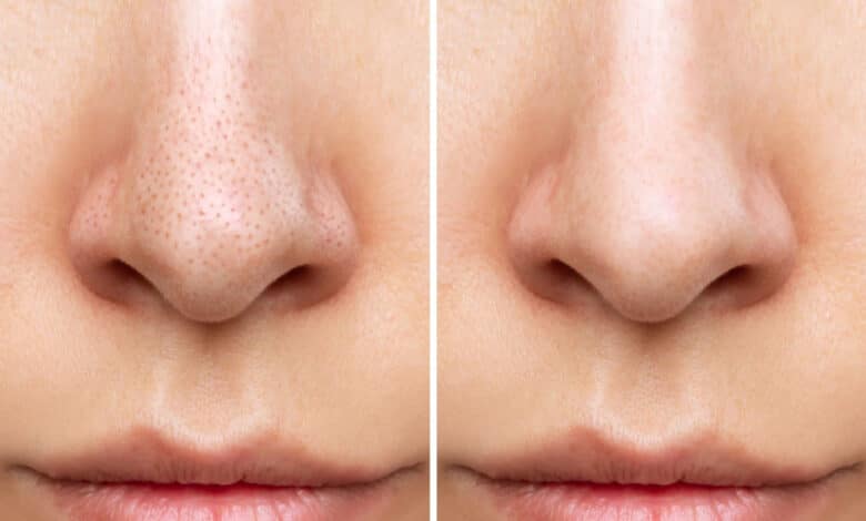 togliere i punti neri