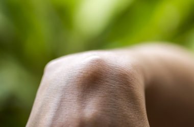 Come prevenire e lenire di effetti delle cisti sebacee: la guida pratica