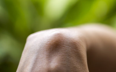 Come prevenire e lenire di effetti delle cisti sebacee: la guida pratica