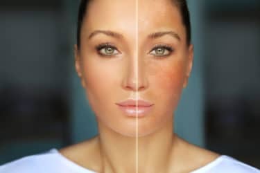 La melanina, il pigmento naturale che dona il colore alla pelle proteggendola dai raggi Uv