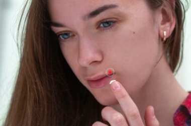 Tutto sull’herpes labiale, quella fastidiosa infezione che ciclicamente compare sulle labbra