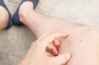 Puntura pappataci: cosa succede agli uomini e ai cani