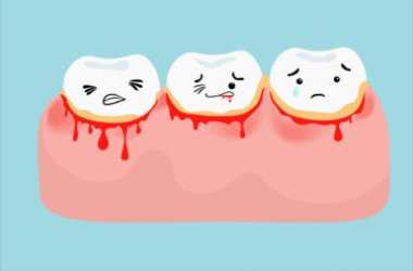 Tutto sulla parodontite o piorrea, la malattia che può portare alla perdita dei denti