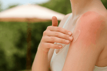 Rimedi naturali per scottature solari: cosa funziona davvero